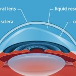Scleral Lens Houston