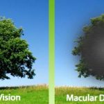 Macular-Degeneration
