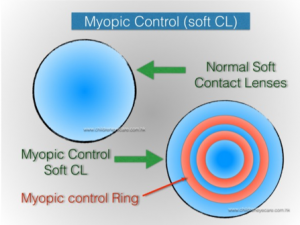 Myopia Control Soft Contact Lenses